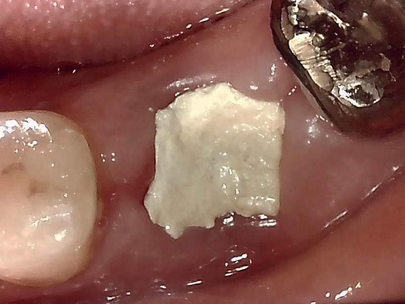 DRY SOCKET、ドライソケット、ドライソケット専門医